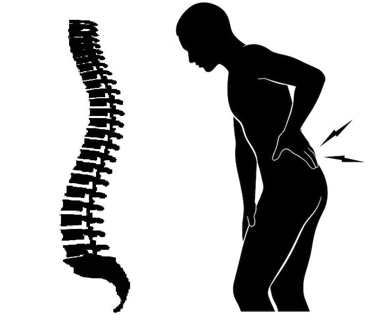 mal di schiena e colonna vertebrale – rappresentazione grafica